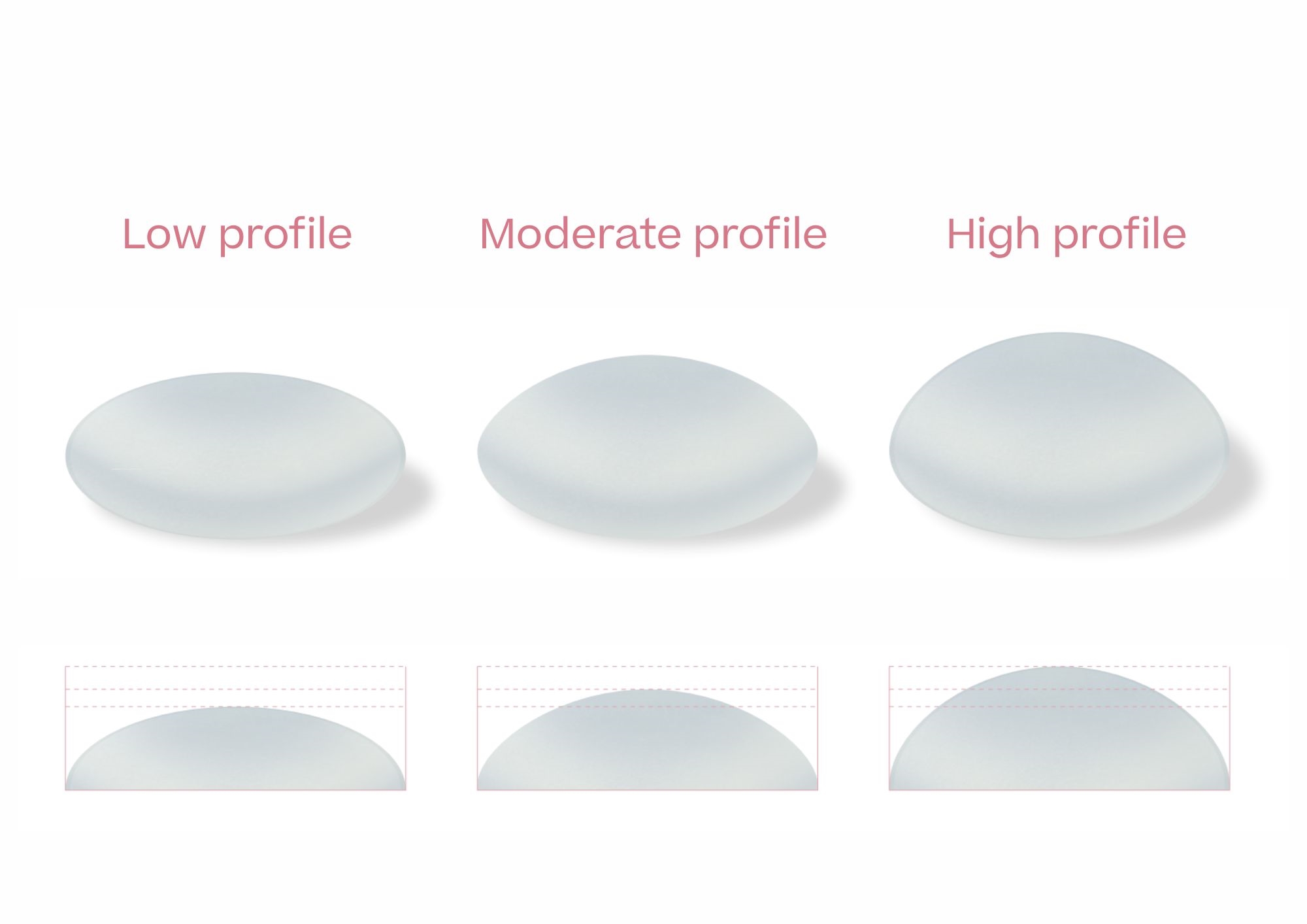Breast implant profile types diagram. low profile moderate profile high profile side view Breast implant profile types diagram. low profile moderate profile high profile side view